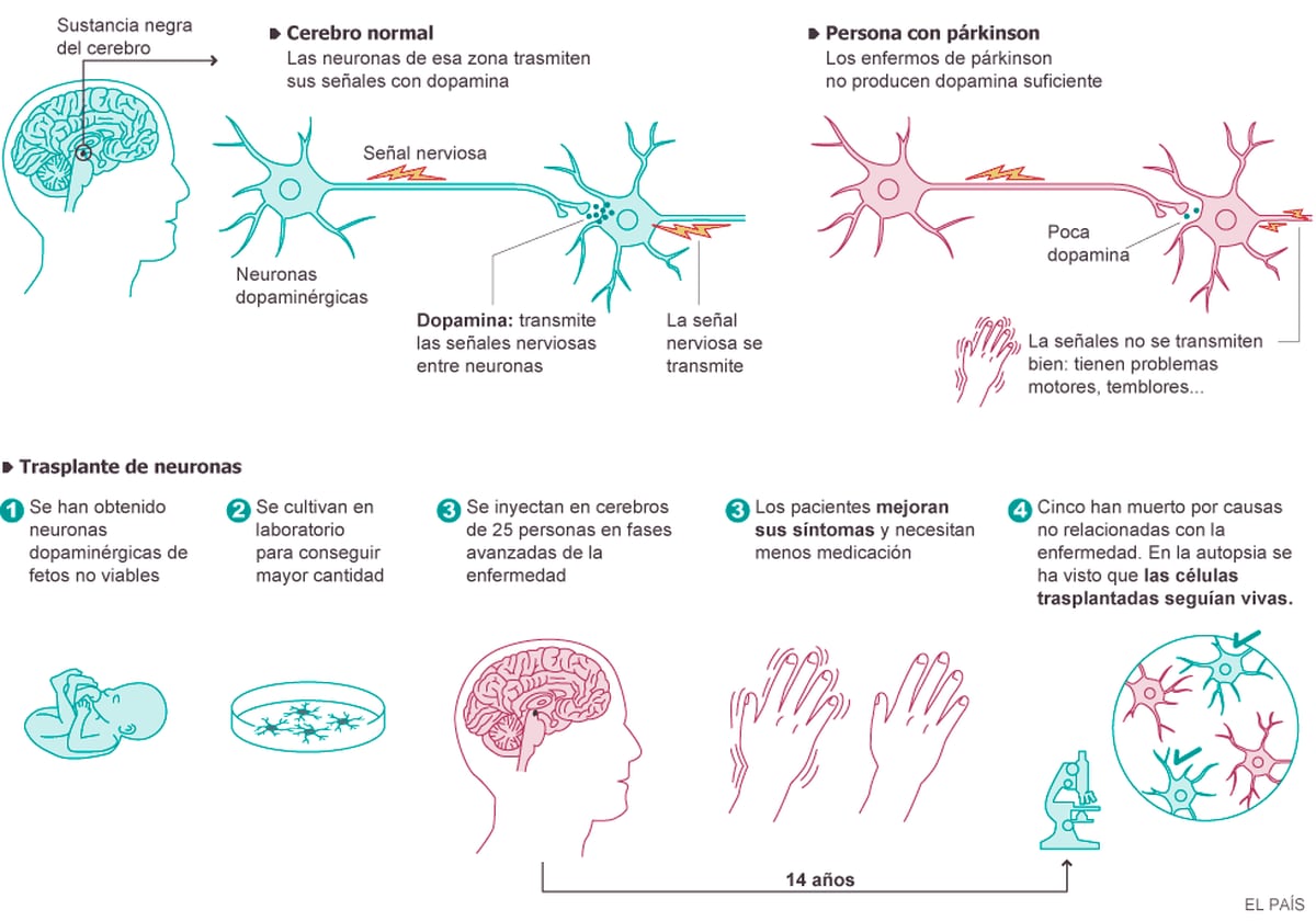 Terapia celular para párkinson Sociedad EL PAÍS