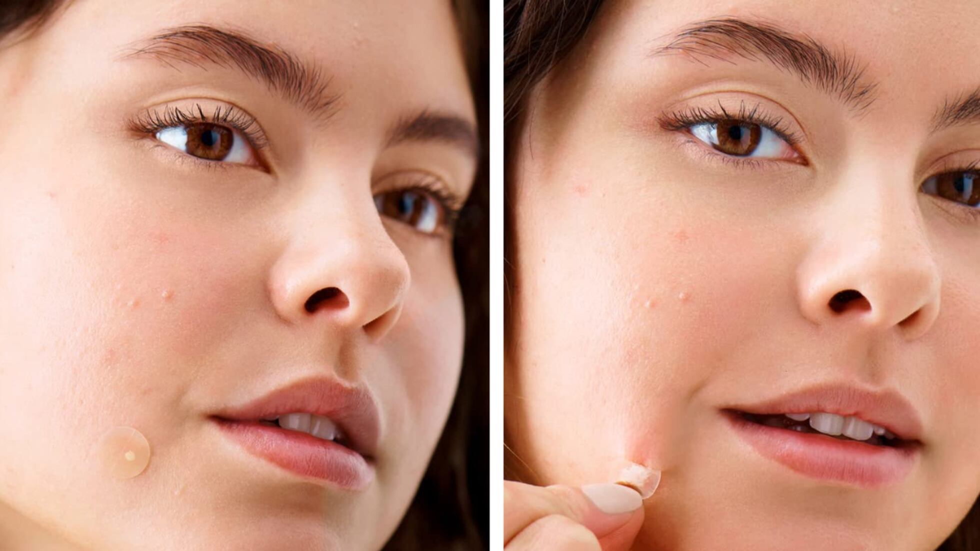 Di adiós a las imperfecciones con los parches para acné superventas en  Amazon | Escaparate | EL PAÍS México