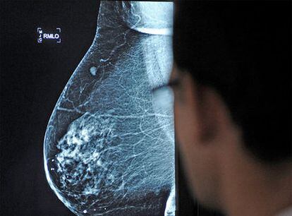 Un médico observa una mamografía realizada en el Hospital Virgen del Rocío de Sevilla.
