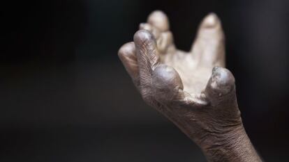La mano de un enfermo de lepra