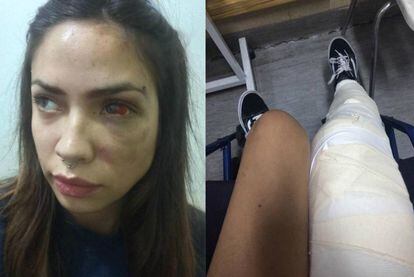 Imágenes que Valentina Henríquez subió a Facebook el 3 de julio. A la izquierda, el rostro de la chilena en la actualidad; a la derecha, cómo quedó tras una agresión de su novio el pasado enero.