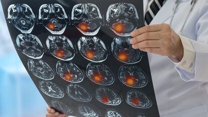 Un neurólogo observa los resultados de una resonancia magnética de un paciente que ha sufrido un ictus.