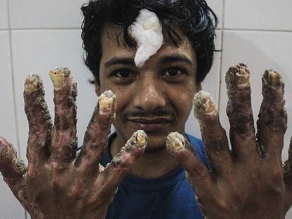 Abul Bajandar, conocido como el 'hombre árbol' de Bangladesh, posa con sus nuevas manos