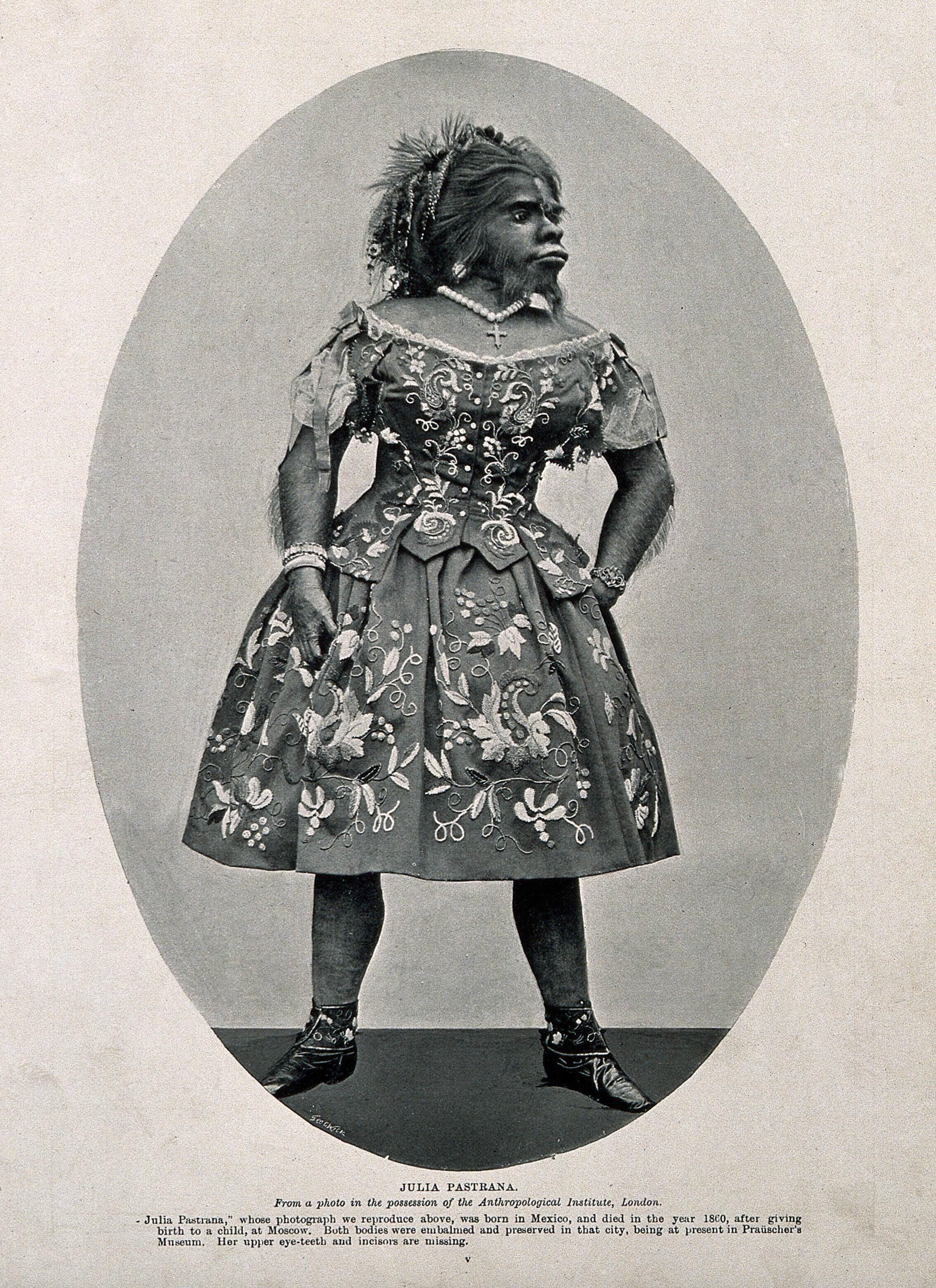 La mexicana Julia Pastrana, fallecida en 1860 a los 26 años.