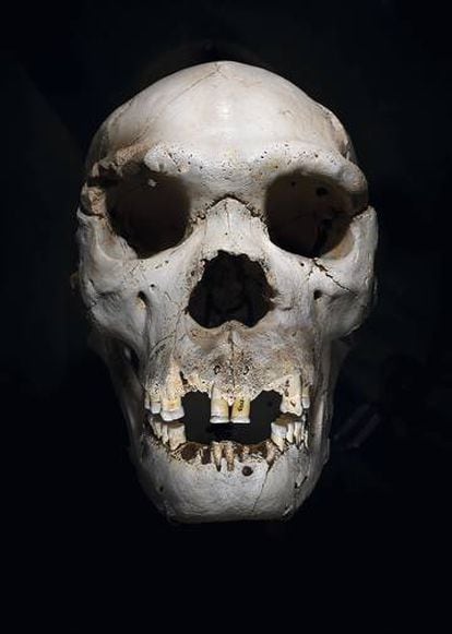 Cráneo de Homo heidelbergensis conocido como Miguelón, hallado en Atapuerca. Se cree que este homínido de hace 400.000 años murió por un flemón, aún visible.