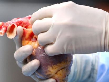 Un doctor examina el coraz&oacute;n de un donante durante un trasplante.