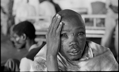 Los estragos del genocidio en el rostro de un superviviente en un hospital de Kabgayi (Ruanda) en 1994.