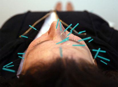 Un hombre recibe una sesión de acupuntura.