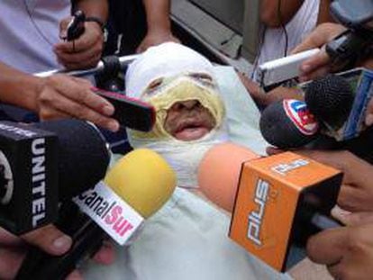 Fotografía tomada el pasado 29 de octubre en la que se registró al periodista boliviano Fernando Vidal, luego de que fuera quemado por desconocidos cuando conducía un programa radial en el pueblo sureño de Yacuiba (Bolivia). EFE/Archivo