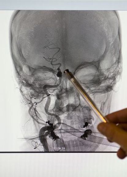 La doctora Blanca Fuentes señala, en una arteriografía, dónde se encuentra alojado el trombo de un paciente.
