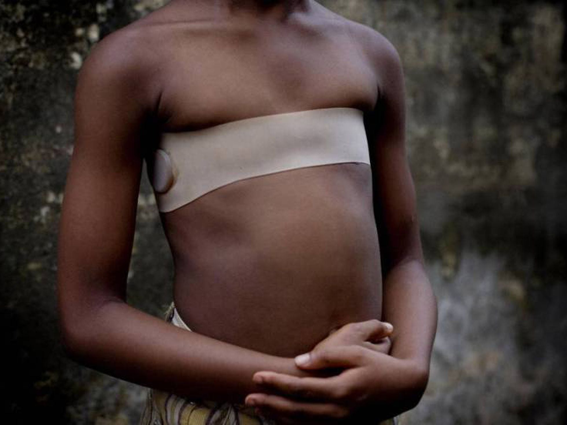 Decaer Iluminar Posesión Planchado de senos: una tortura a las niñas para que no lleguen a mujeres |  Planeta Futuro | EL PAÍS