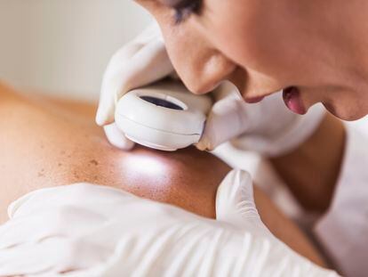 El cáncer de piel se clasifica en melanoma y carcinoma. En España se diagnostican 78.000 nuevos casos al año.