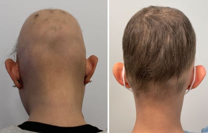 Baldness cure