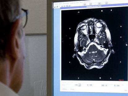 Los tumores cerebrales benignos provocan cefaleas, trastornos del sue&ntilde;o y obesidad.