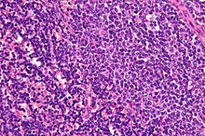 Células de leucemia linfática crónica.