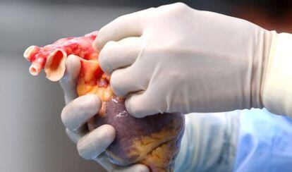 Un doctor examina el corazón de un donante durante un trasplante.