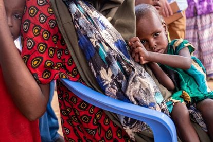 Un niño que sufre de desnutrición severa, en Somalia.