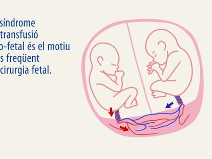 Sant Joan de Déu crea un GPS per millorar la cirurgia fetal