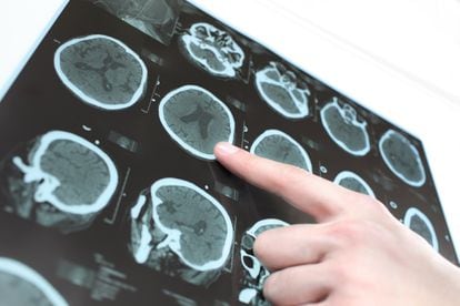 Un neurólogo señala las imágenes de un cerebro humano obtenidas por escáner.