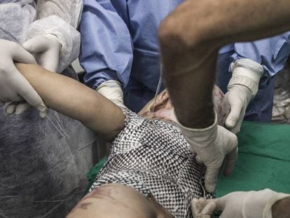 Varios médicos aplican piel de tilapia en un bebé de un año y medio, quemado con agua caliente, en hospital de Fortaleza (Brasil).