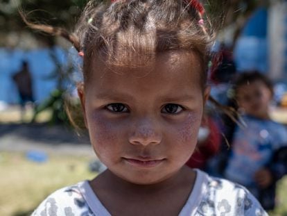 Una niña venezolana muestra las lesiones que sufre en su rostro por el frío y el sol, mientras pasa sus días en las calles de Iquique buscando la manera de llegar a la capital chilena, Santiago.