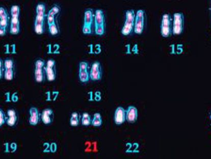 Cromosomas de un varón con síndrome de Down donde se ven las tres copias del 21.