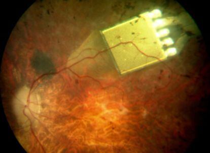 Imagen de un implante electrónico en un ojo para reemplazar la retina.