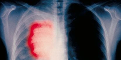 Radiografía de un fumador con cáncer de pulmón.