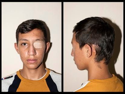 Nicolás Bernal, de 13 años, sufrió un traumatismo craneal durante las protestas por el impacto de un bote de gas lacrimógeno, en Bogotá, Colombia.