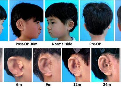 Im&aacute;genes de uno de los pacientes tratado con la nueva t&eacute;cnica para implantar una nueva oreja. 