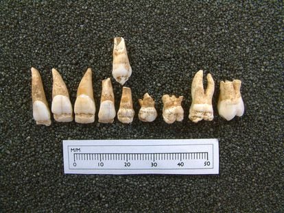Los dientes de casi todos los niños tenían hipoplasia, un desarrollo incompleto del esmalte provocado por la desnutrición y las enfermedades. En la imagen, los del individuo identificado como SK 232.