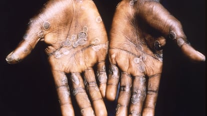 Fotografía de las lesiones provocadas por la viruela del mono, durante un estudio en la República Democrática del Congo entre 1996 y 1997.
