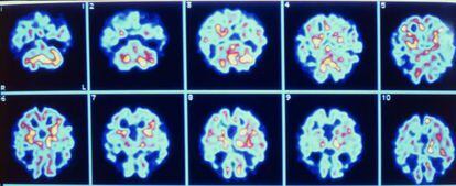 Imágenes de un cerebro con alzhéimer.