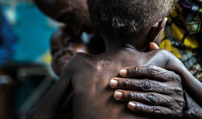 Unos gemelos desnutridos de 17 meses son llevados al centro de salud de Ditekemena, en República Democrática del Congo, por sus abuelos. Estuvieron cinco meses ocultos entre el matorral, después de que las milicias atacasen su aldea. Los padres fueron asesinados y los bebés sufrieron varias cuchilladas.