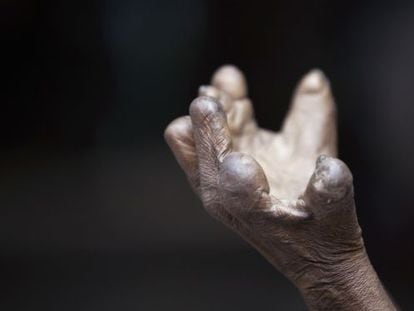 La mano de un enfermo de lepra 