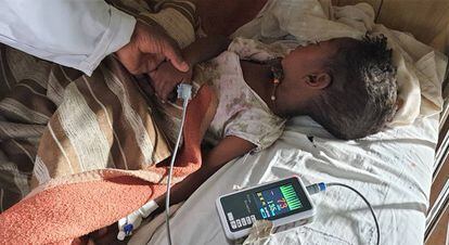 Meseret ingresó en hospital rural de Gambo (Etiopía) con un sarampión grave complicado con afectación respiratoria.