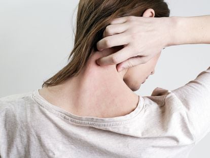 Una mujer que sufre psoriasis se rasca la nuca.