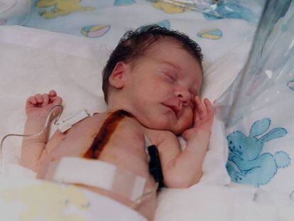 La niña 'Baby Fae' recibió en 1984 el corazón de un mandril.