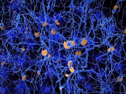 Ilustración por ordenador de placas amiloides entre neuronas.