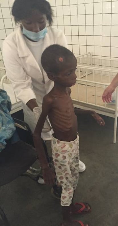 Marcos, se levanta para demostrar que se encuentra mejor en una de las salas de desnutridos del hospital, en Cubal (Angola).