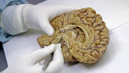 Lecanemab fármaco contra el alzhéimer