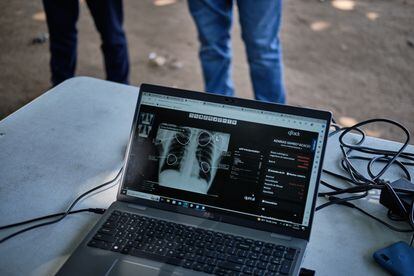 Resultado con señales radiológicas de tuberculosis obtenido con la máquina de rayos X portátil en la prisión provincial de Maputo. Los trabajadores de prisiones recogen, además, datos relativos al estado nutricional de los reclusos, la presión sanguínea e índice de masa corporal, que ingresan en tabletas sincronizadas. 
