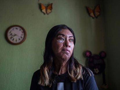 Esmeralda Millán, quien sobrevivió a un ataque con ácido por parte de su expareja, posa para un retrato en la casa de su abuela en el Estado de Puebla (México), el 22 de junio de 2021.