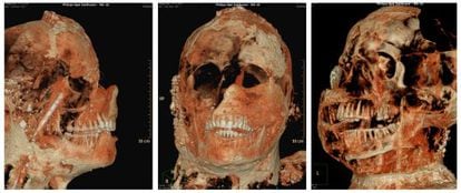 Una tomograf&iacute;a axial computarizada de una de las momias de Pompeya. 