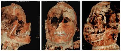 Una tomografía axial computarizada de una de las momias de Pompeya.
