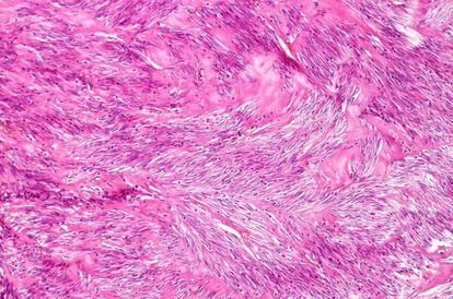 Imagen microscópica del estroma, el tejido 'coraza' de los tumores sólidos.