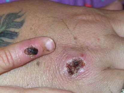Erupción cutánea de una paciente con el virus de la viruela del mono, en Illinois en 2003.