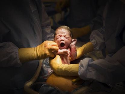 Un bebé nacido por cesárea.