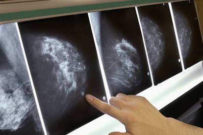 Mamografías de seguimiento de un tumor.