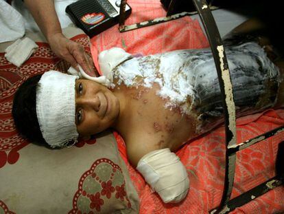 Ali Smain, el niño iraquí de 12 años que perdió los brazos y a su familia en un bombardeo de la coalición angloestadounidense sobre Bagdad, fotografiado en una cama de hospital de un hospital de la ciudad.